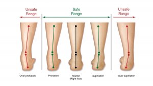 Пронация и гиперпронация стопы: что это такое?