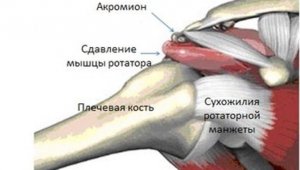 Мобилизация при синдроме сдавления ротаторов плеча